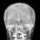 An example of what a deep brain stimulation device looks like under X-ray imaging.